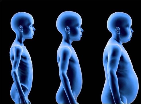 Representación visual de la malnutrición infantil